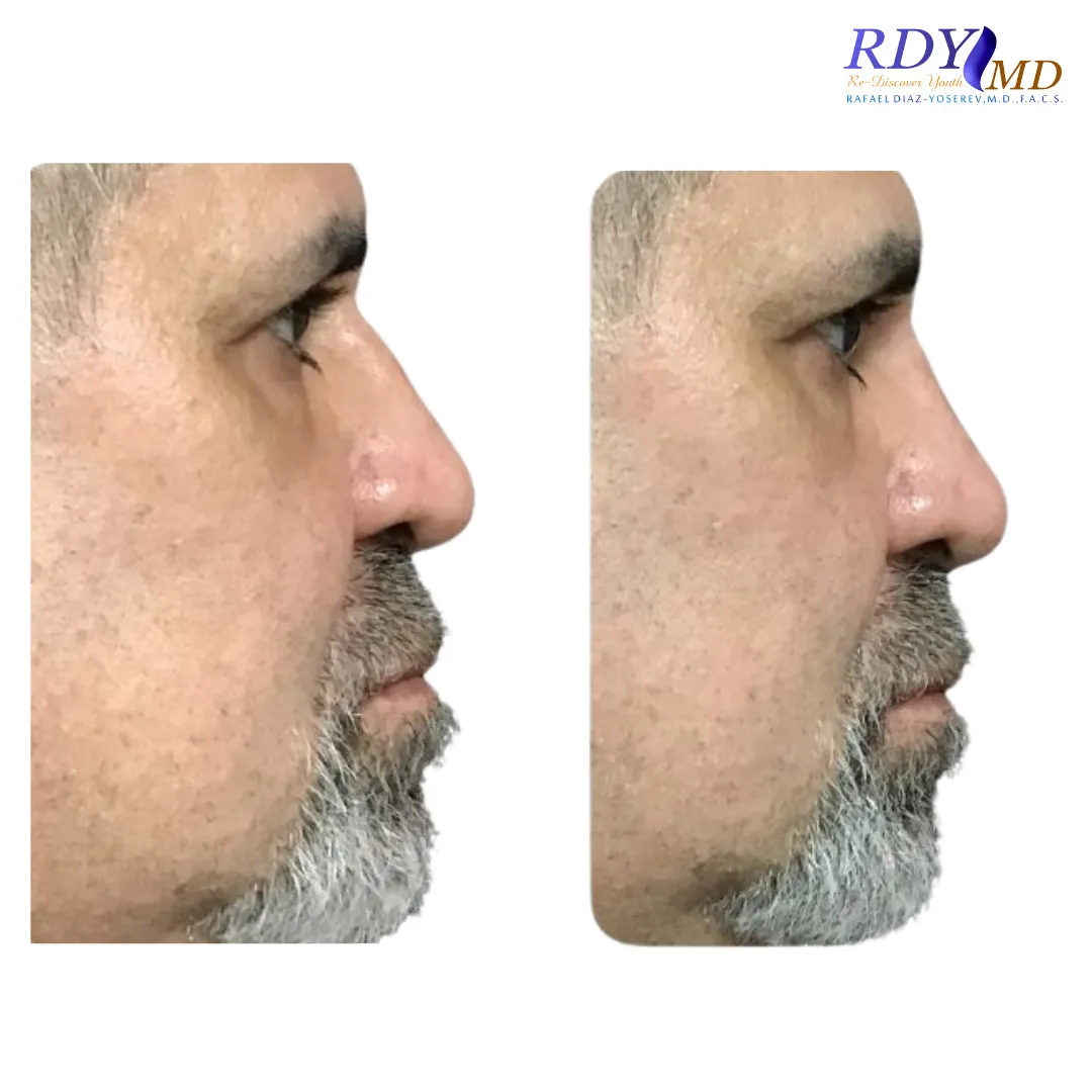 Men's Aesthetic Procedures 3 Before and after photos showing the results of a non-surgical nose job using dermal fillers