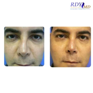 Men's Aesthetic Procedures 2 Before and after photos showing the results of a non-surgical nose job using dermal fillers