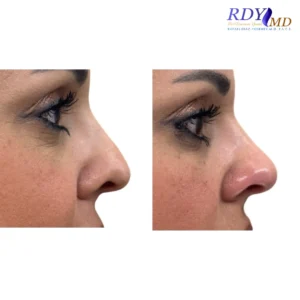 Before and after photos showing the results of a non-surgical nose job using dermal fillers