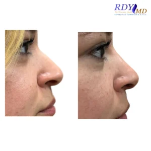 Before and after photos showing the results of a non-surgical nose job using dermal fillers