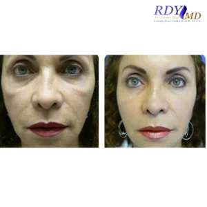 dermal fillers , facial balancing, harmonization, voluma lift, liquid facelift