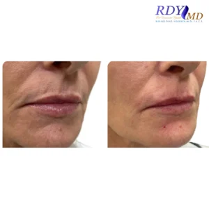 Before and after photos of a patient showing the results of lip filler treatment