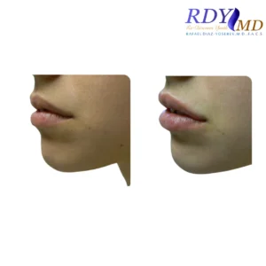 Before and after photos of a patient showing the results of lip filler treatment