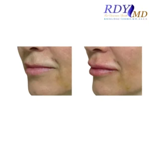 Before and after photos of a patient showing the results of lip filler treatment