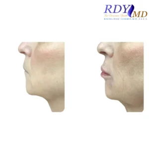 Before and after photos of a patient showing the results of lip filler treatment