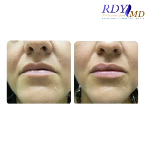 Before and after photos of a patient showing the results of lip filler treatment