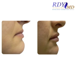 Before and after photos of a patient showing the results of lip filler treatment
