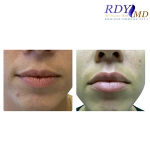 Before and after photos of a patient showing the results of lip filler treatment