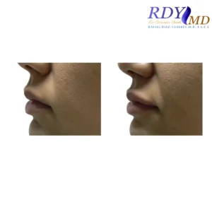 Before and after photos of a patient showing the results of lip filler treatment