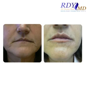 Before and after photos of a patient showing the results of lip filler treatment