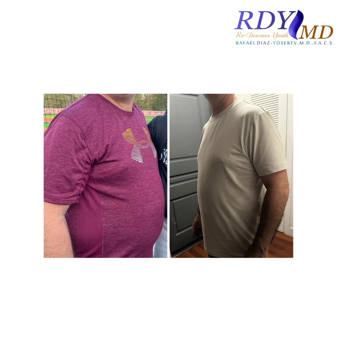 WEIGHT LOSS with semaglutide