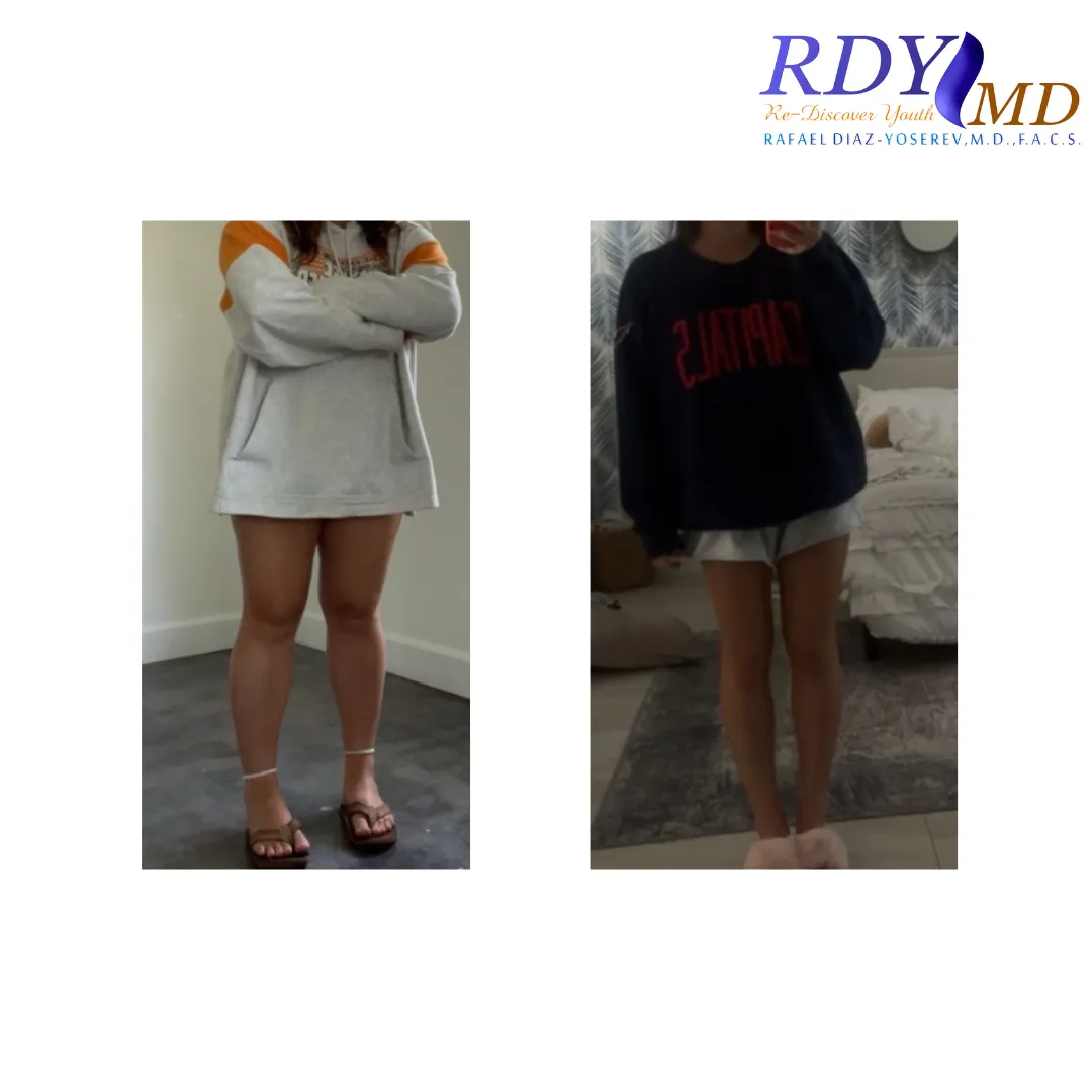 WEIGHT LOSS with semaglutide