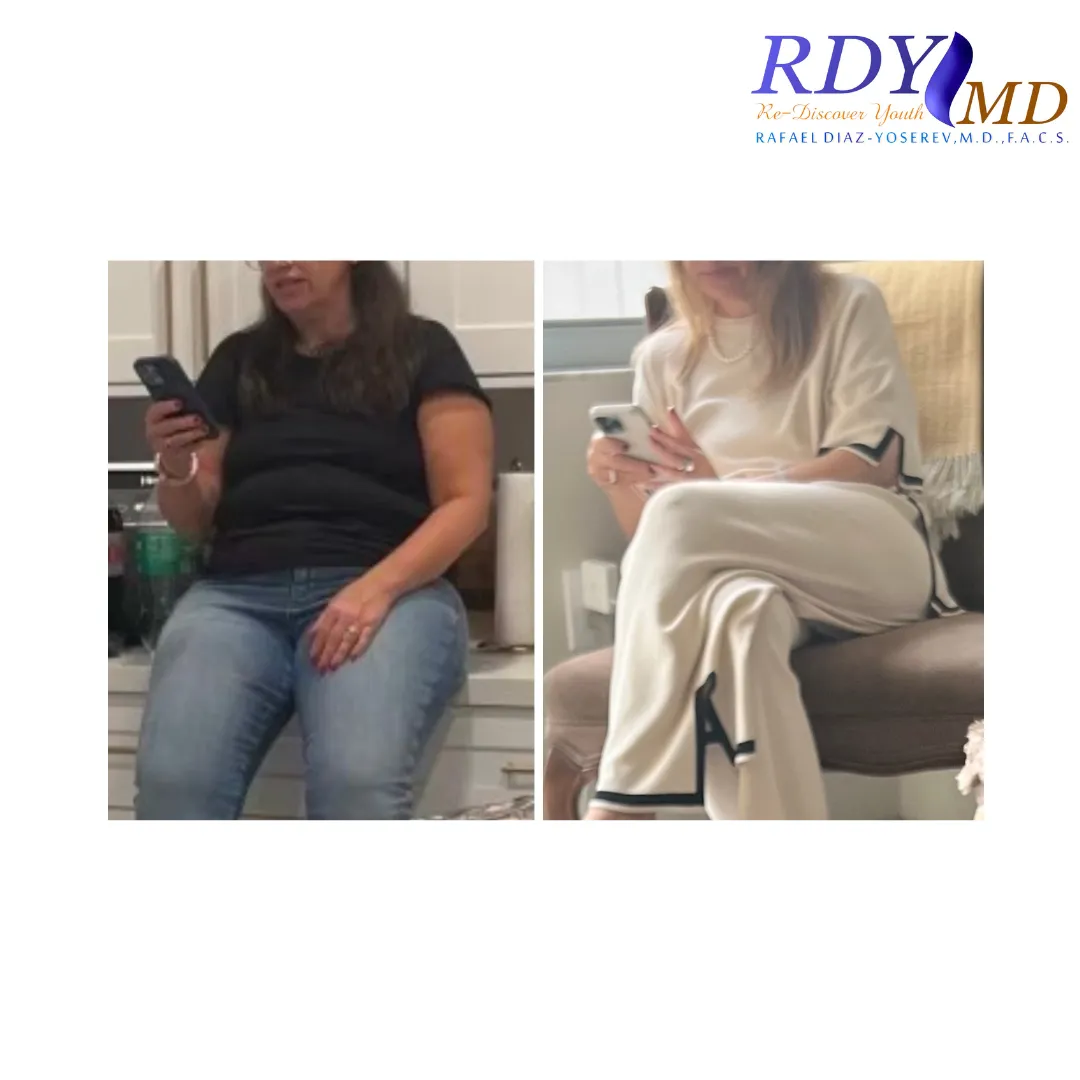 WEIGHT LOSS with semaglutide