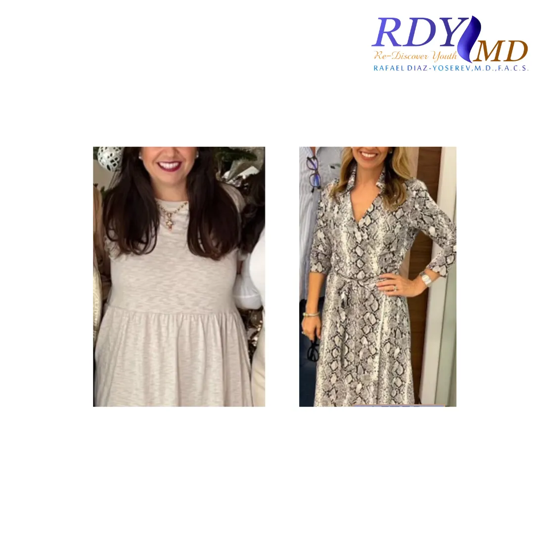 WEIGHT LOSS with semaglutide