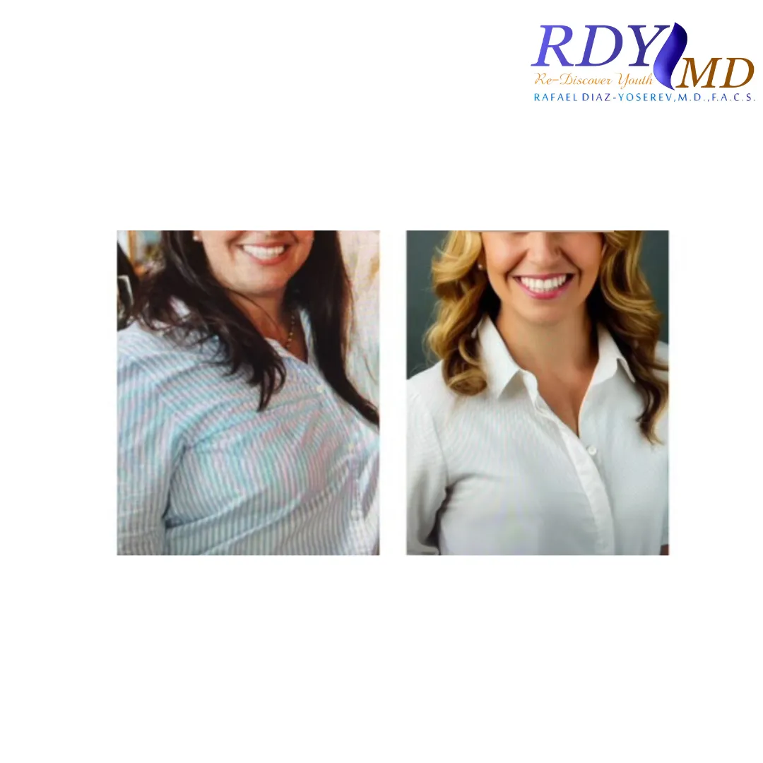 WEIGHT LOSS with semaglutide