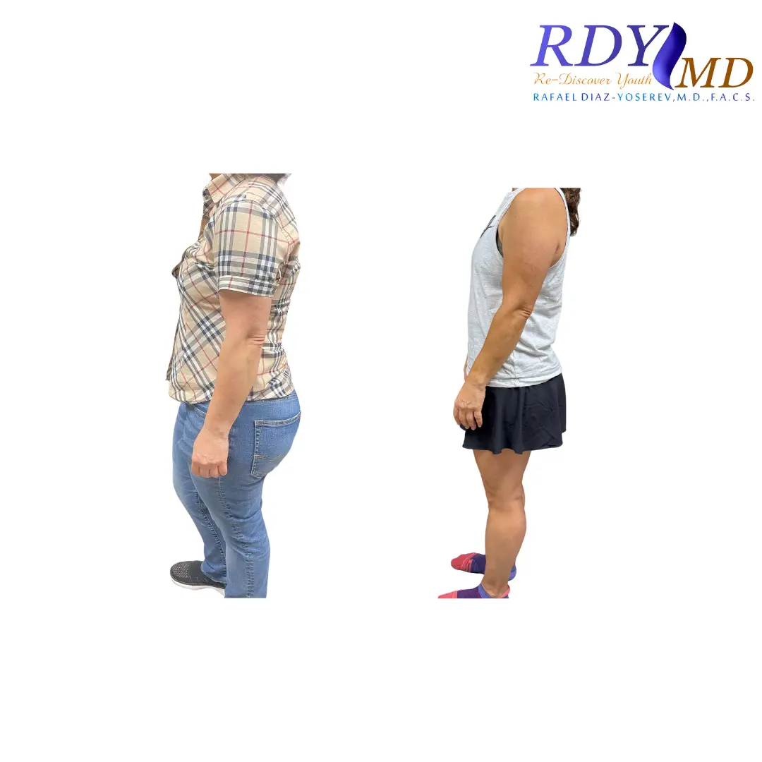 Weight Loss Before & After