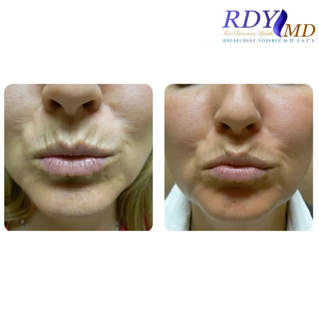 botox for upper lip vertical lines in miami