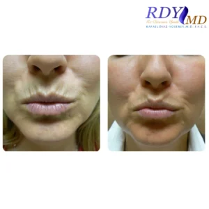 botox for upper lip vertical lines in miami