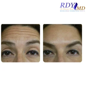 Before and after Botox (Botulinum Toxin A) treatment at RDYMD Coral Gables smoothing forehead wrinkles.