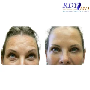 Botox before and after photos showing youthful skin at RDYMD Coral Gables