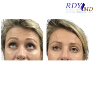 Xeomin treatment smoothing fine lines on the forehead at RDYMD Miami location.