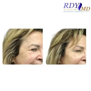 Patient getting Botox for crows feet in Miami