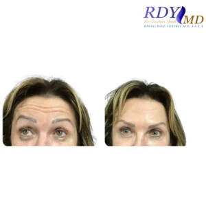 Before and after Botox for expression lines on forehead at RDYMD Coral Gables Miami.