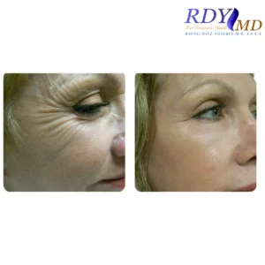 Patient’s eyes before and after Xeomin treatment for crow’s feet at RDYMD Miami.
