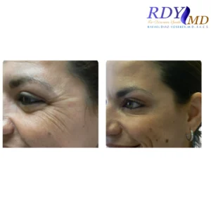 Xeomin treatment results on crow’s feet before and after at RDYMD Miami.