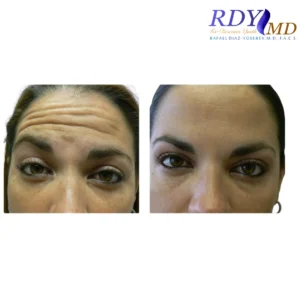 Natural-looking results of Xeomin injections on forehead wrinkles at RDYMD Miami.
