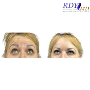 Before and after Botox for wrinkle reduction on the forehead at RDYMD Coral Gables.