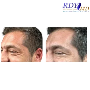 Visible reduction of crow’s feet after Xeomin injections at RDYMD Miami location.