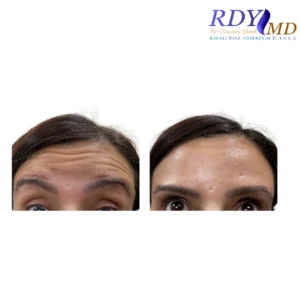 Patient’s forehead before and after Botox treatment at RDYMD Coral Gables Miami.