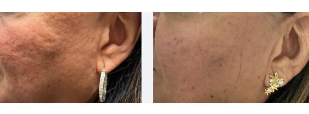 Visible skin tightening and improved acne scars following diluted Radiesse biostimulator treatment.