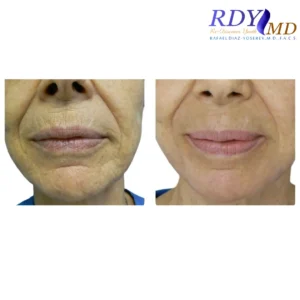 CO2 LASER SKIN RESURFACING