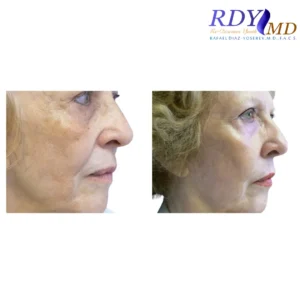 CO2 LASER SKIN RESURFACING