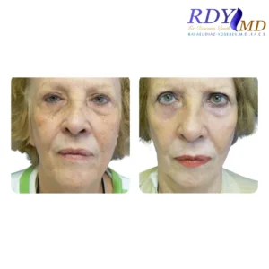 CO2 LASER SKIN RESURFACING