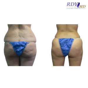Body Contouring 2 Before and after image showing the results of a fat transfer procedure.