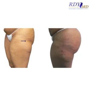 Body Contouring 4 Before and after image of butt enhancement augmentation with fat transfer, showing improved volume, shape, and contour of the buttocks.