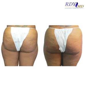 Body Contouring 3 FAT TRANSFER BBL HIP DIPS