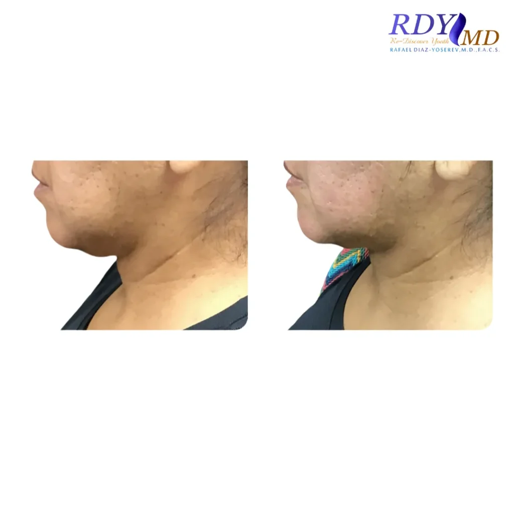 FRACTORA FIRM-FORMA RADIOFREQUENCY SKIN TIGHTENING