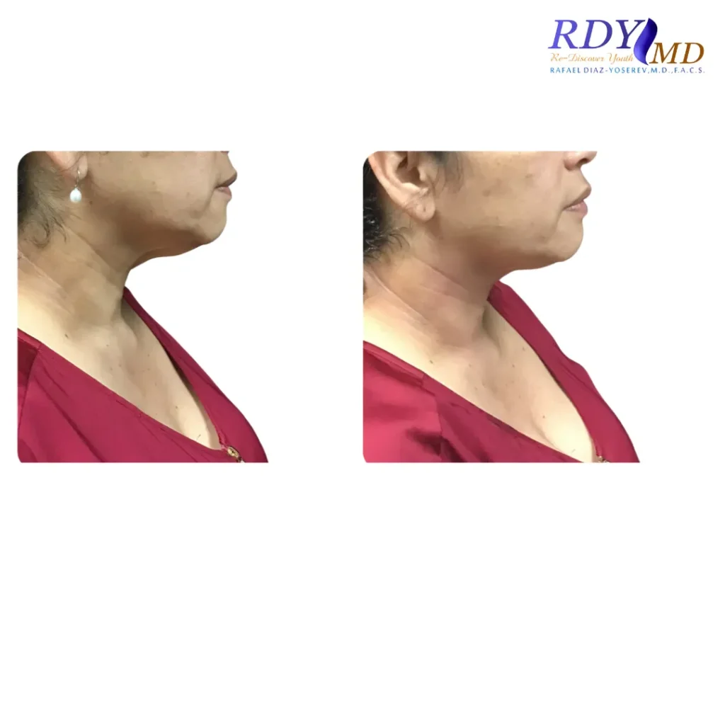 FRACTORA FIRM-FORMA RADIOFREQUENCY SKIN TIGHTENING