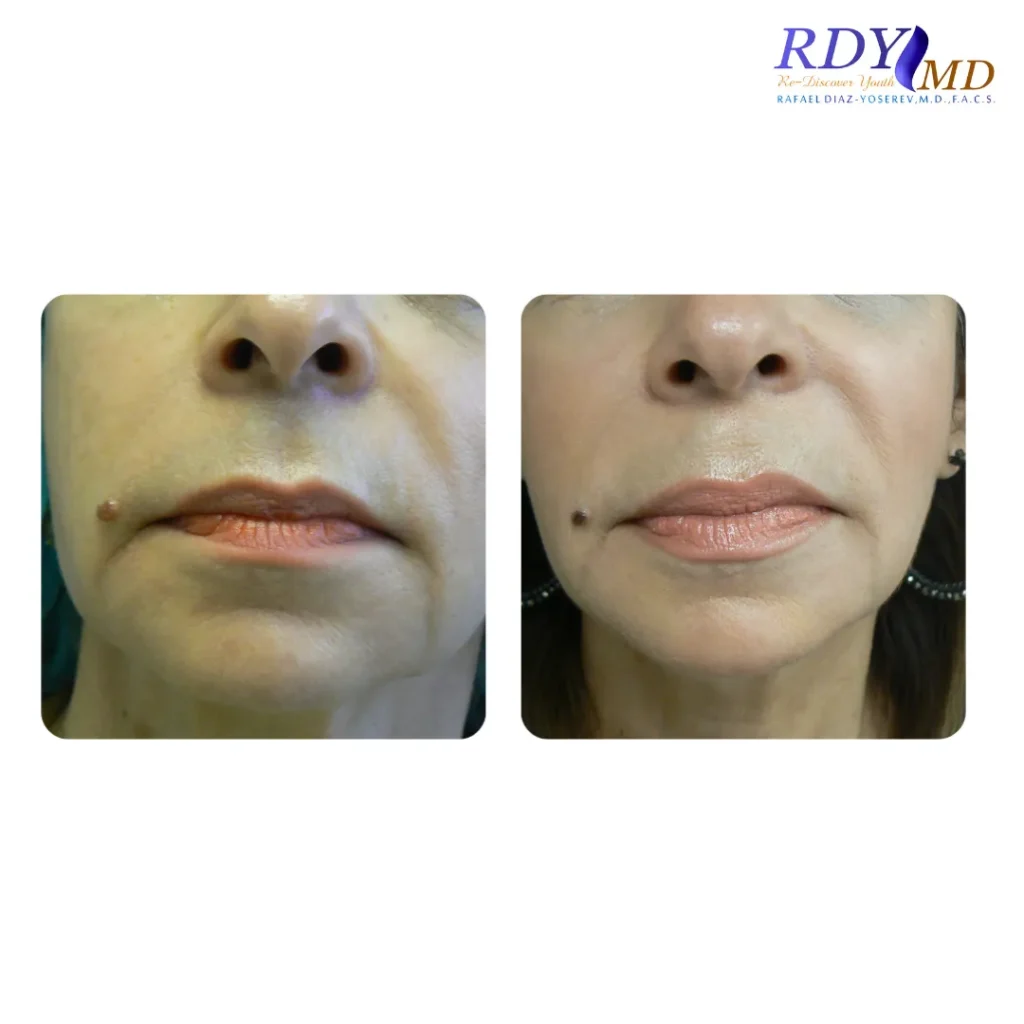 FRACTORA FIRM-FORMA RADIOFREQUENCY SKIN TIGHTENING