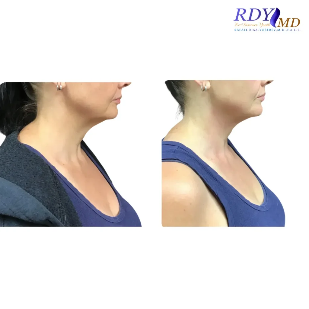 FRACTORA FIRM-FORMA RADIOFREQUENCY SKIN TIGHTENING