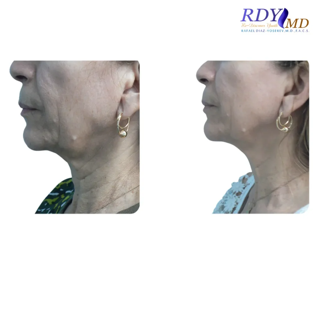 FRACTORA FIRM-FORMA RADIOFREQUENCY SKIN TIGHTENING