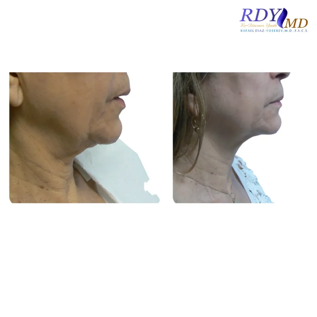 FRACTORA FIRM-FORMA RADIOFREQUENCY SKIN TIGHTENING