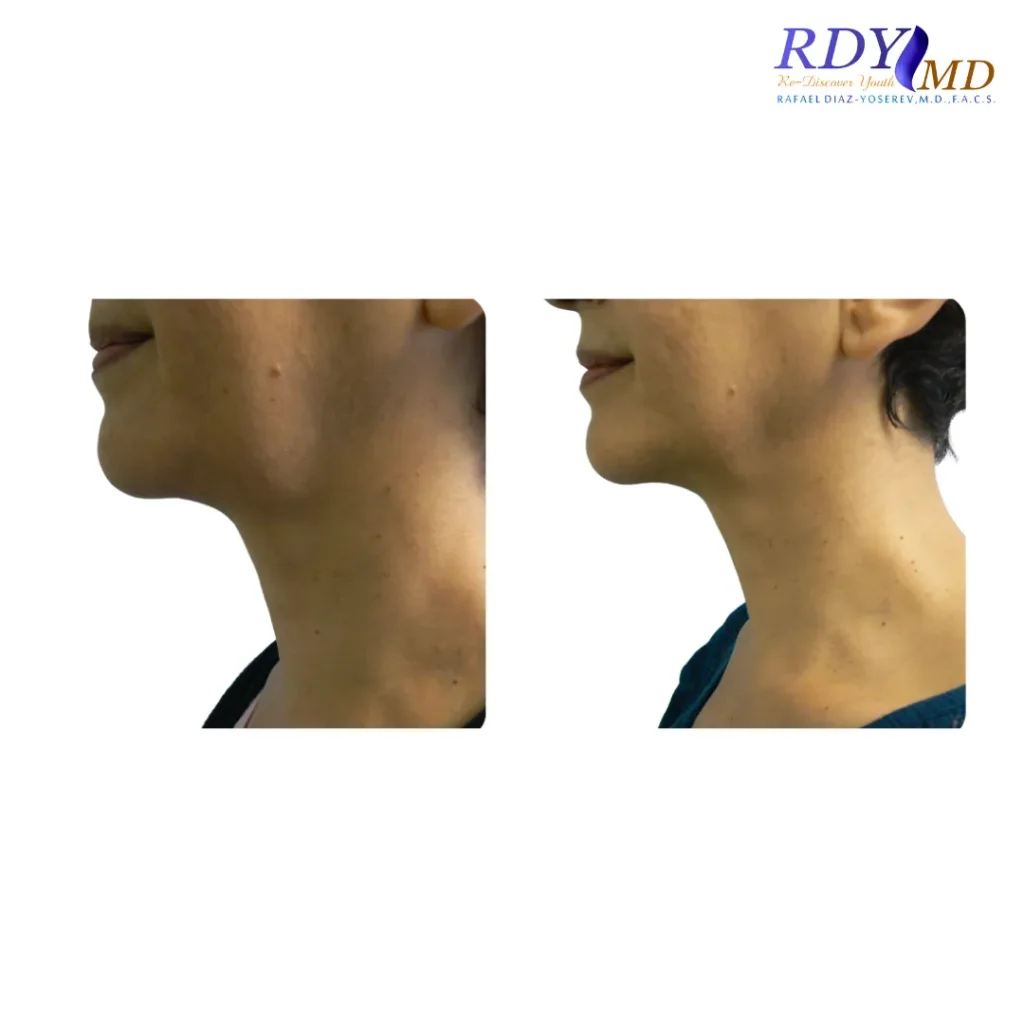 FRACTORA FIRM-FORMA RADIOFREQUENCY SKIN TIGHTENING