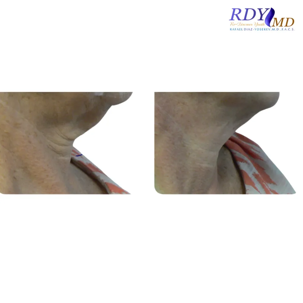 FRACTORA FIRM-FORMA RADIOFREQUENCY SKIN TIGHTENING