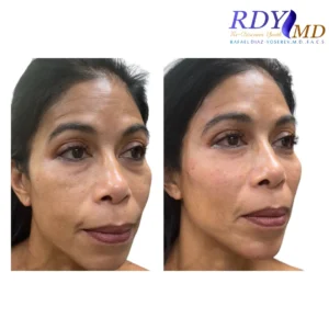 RENUVA before and after picture, cheek contour