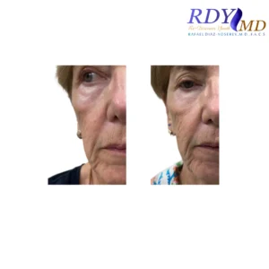 RENUVA filler before and after pic of midface